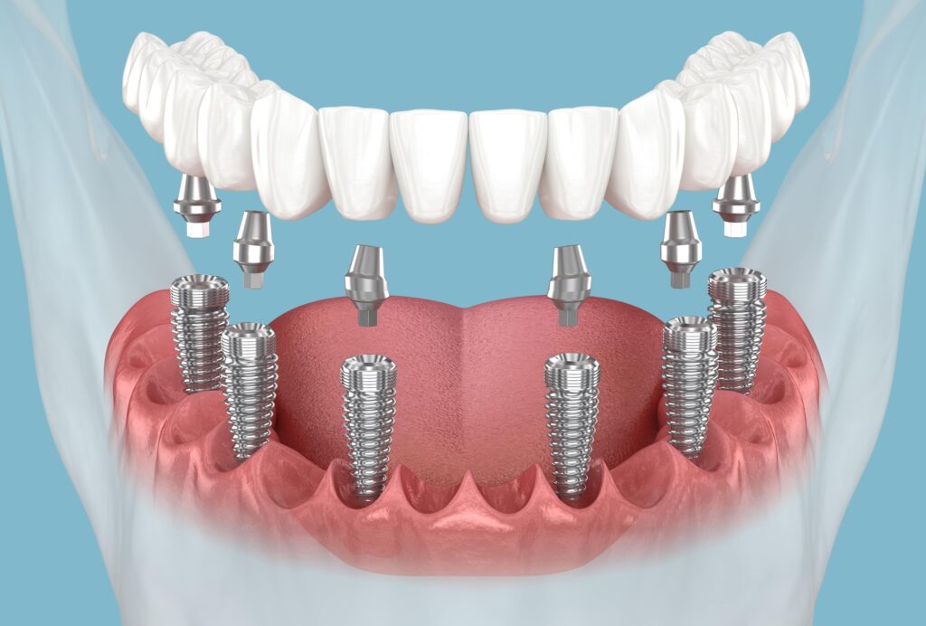 Dental Implants and dentures